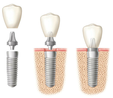 Diagram of a dental implant to show how it differs from a dental bridge. The first figure is of an implant with a separate abutment and crown,. The second shows the implant in bone tissue with the abutment and crown above it, but unsecured. The third diagram shows the implant in the jawbone with the abutment and crown secured. This information is provided for the office of Bakersfield dentist Dr. Thomas Frank.