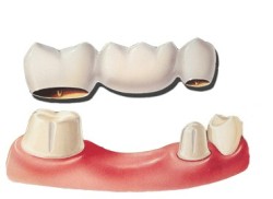 Diagram of a dental bridge suspended above two shaved-down teeth, for information on dental bridges and implants from Bakersfield, CA dentist Dr. Thomas Frank.